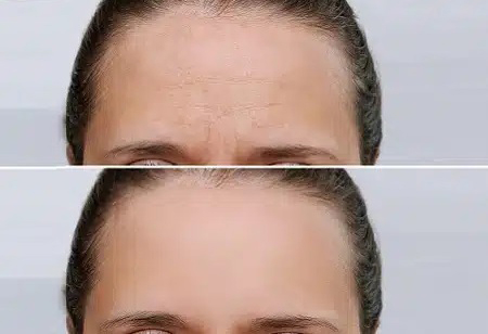 Tratamiento Botox antes y despues en ciudad de México CDMX